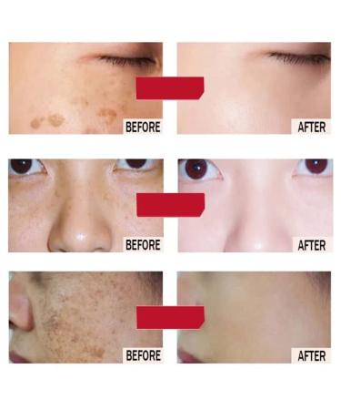 Axnoocy Dark Spot Remover Cream - Instant Results for Blemish, Melasma, Freckle, Sun Spot Removal - 0.71fl.oz - Suitable for All Skin Types - Buy Online on GoSupps.com