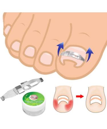 3pcs Stainless Steel Ingrown Toenail Corrector Set for Pain Relief and Paronychia Treatment - Buy Online on GoSupps.com