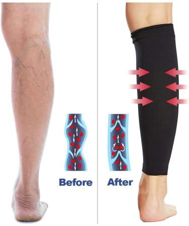 Beister Calves Medical Compression Stockings for Men & Women | 20-30 mmHg Varicose Veins & Thrombosis Protection | Black XL - Buy Online on GoSupps.com