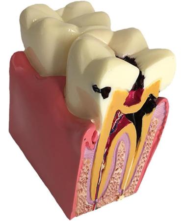 Colcolo Teeth Model - 6X Caries Comparison Examination Models for Study & Research | International Shipping Available - Buy Online on GoSupps.com