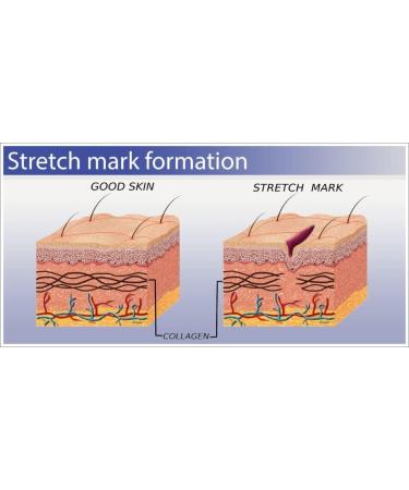 Ultimate Stretch Mark Repair Product with 20% Collagen 20% Retinol 20% Hyaluronic Acid & 20% Elastin - Buy Online on GoSupps.com