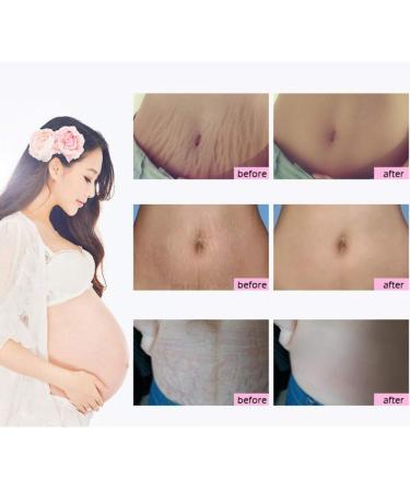 Best Stretch Mark Cream for Pregnancy & Postpartum - Repair & Remove Scars - Buy Online on GoSupps.com
