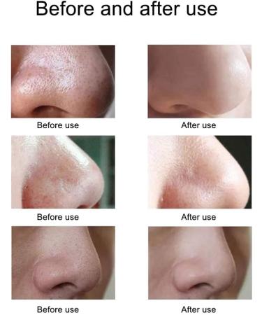 Benkeg Blackhead Remover - Electric Blackhead Suction Device with 5 in 1 Pimple Zit Comedone Extractor Tool Acne Removal kit Blackhead Remover Household Face Pore Cleaner Cosmetic Instrument White with 5pcs needles - Buy Online on GoSupps.com