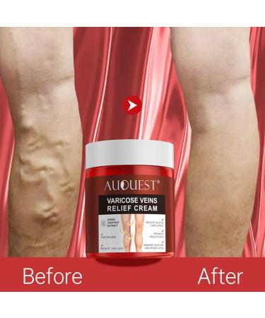 Varicose Vein Relief Cream Set - Auquest Treatment for Legs with Patches - Spider Veins Repair - Buy Online on GoSupps.com