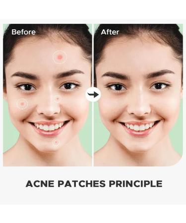 Bizzal 72 Patches Tea Tree Oil Invisible Waterproof Hydrocolloid Acne Pimple Patches for Spot Treatment Fast Healing Skin Care Protection Blemish Cover Overnight Zit Remover - Buy Online on GoSupps.com