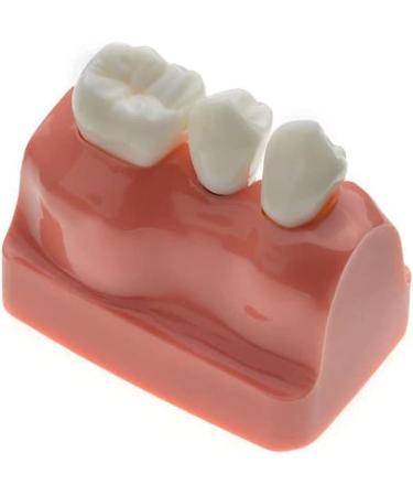 Samnuerly Dental Implant Model | 4-Way Analysis & Training Tool for Crown & Bridge Demonstration - International Shipping Available - Buy Online on GoSupps.com