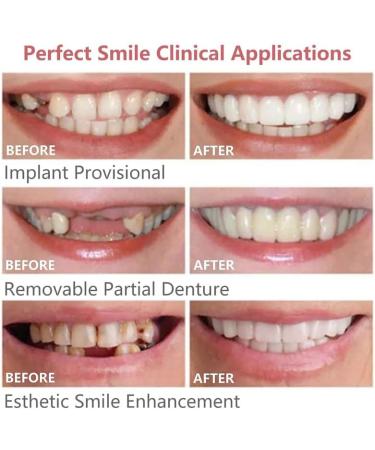 Brigtviee 2 Pairs ClipIn Veneers ClickOn Veneers Upper and Lower Teeth Cosmetic Fake Teeth Instant Veneers Dentures Adjustable Temporary Fake Teeth for Men and Women - Buy Online on GoSupps.com