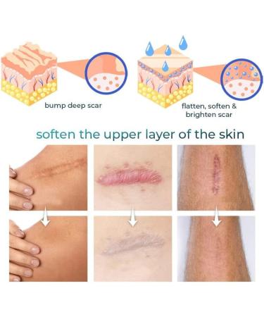 Kelo-cote Scar Gel 15g-2 Pack | Advanced Formula for Surgical, Stretch Marks, C-section, Cosmetic Surgery, Burn & Children's Scars | Softens, Flattens, Eliminates Redness - Buy Online on GoSupps.com