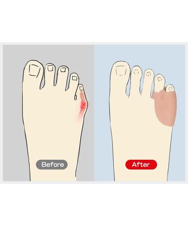 Norhogo Silicone Toe Separator - 4 Pairs for Pinky & Overlapping Toes Relief | Comfortable Toe Spreader for Pain & Pressure Relief - Buy Online on GoSupps.com