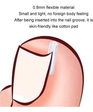 Corrective for Ingrown Nails Correction of Ingrown Nails Correction Kit 30 Pieces Correction Strips for Ingrown Nails Toe Nail Correction - Buy Online on GoSupps.com