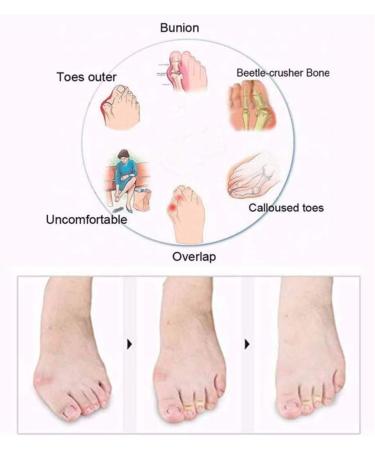 LLIMUE Orthopedic Foot Corrector Sandals with Arch Support for Bunion Pain Relief - Brown, Size 40 - Buy Online on GoSupps.com