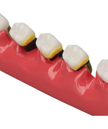Dental Parodontitis Model - Visualize Stages & Improve Communication Between Dentists and Patients | International Shipping - Buy Online on GoSupps.com