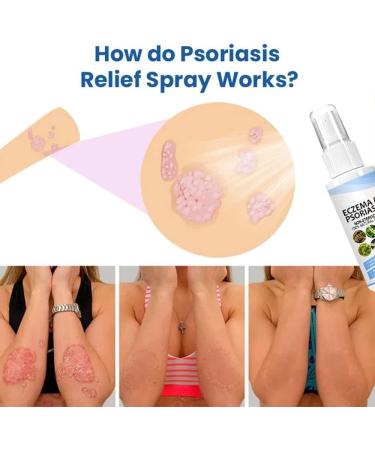 BLEDD Melllop Herbal Psoriasis & Vitiligo Relief Spray 2023 - Itchy Skin Relief - Psoriasis & Vitiligo Spray - 1pcs - Buy Online on GoSupps.com