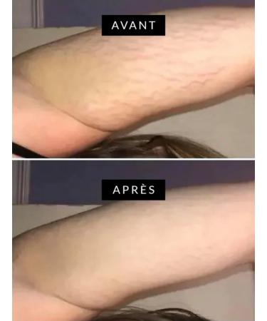  G n rique Super Effective Stretch Mark Peel Black Soap 100g - Buy Online on GoSupps.com