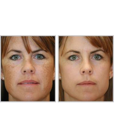 Acne-Aid Liquid Cleanser Oily Skin 100Ml Colour | White Red Volume | 100 Ml -Soap-free formula Cleanser - For Acne Prone and oily skin -Restores skin's moisture barrier - Buy Online on GoSupps.com