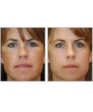 Acne-aid Liquid Gentle Cleanser Hypoallergenic 100 Ml. Free Handmade Envelopes Gift  - Buy Online on GoSupps.com