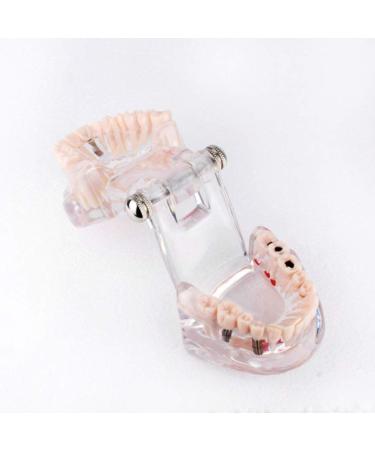 Cocoarm Removable Tooth Model - Dental Care Demo Tool for Teaching Study & Implant Education - Buy Online on GoSupps.com