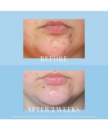 Kate Somerville EradiKate Clarifying Acne Gel Cleanser - 4 Fl Oz - Buy Online on GoSupps.com