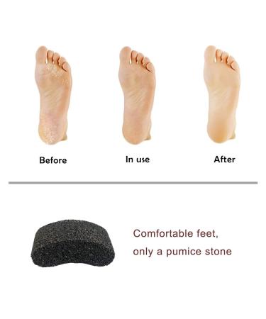 Bicrops Natural Lava Pumice Stone Pedicure Tool Set - Hard Callus Dead Skin Remover & Foot File for Exfoliation - Fine Foot Scrubber for Smoothing Skin - 2 Count - Buy Online on GoSupps.com
