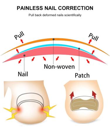 Toenail Patch Toenail Correction Patch Toenail Correction Patch Corrector Pedicure Ingrown Toenails Tool for Ingrown Toenails 50 Pieces - Buy Online on GoSupps.com