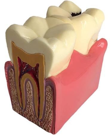 Colcolo Teeth Model - 6X Caries Comparison Examination Models for Study & Research | International Shipping Available - Buy Online on GoSupps.com