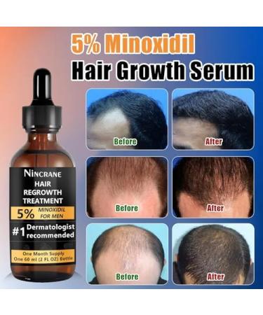 5% Minoxidil for Men - Extra Strength Hair & Beard Growth Kit | Effective Hair Loss Solution & Topical Serum - Buy Online on GoSupps.com