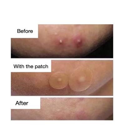 Pimple Patches 180 Count with Tweezers - Hydrocolloid Acne Cover Patch for Quick Healing - Spot Stickers for Face and Skin - Buy Online on GoSupps.com