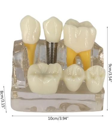 4x Dental Implant Teeth Model with Removable Crown - Crown & Bridge Dentist Training Tool for Patient Analysis | International Shipping - Buy Online on GoSupps.com