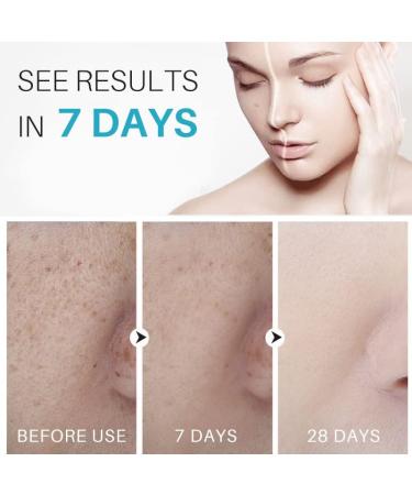 Dark Spot Remover For Face Hyperpigmentation Treatment Dark Spot Serum Melasma treatment for face Blemish spot treatment Freckle Remover for Sun Spots Acne Scars Melasma for Men & Women 30g - Buy Online on GoSupps.com