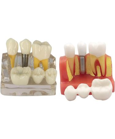 4x Dental Implant Teeth Model with Removable Crown - Crown & Bridge Dentist Training Tool for Patient Analysis | International Shipping - Buy Online on GoSupps.com