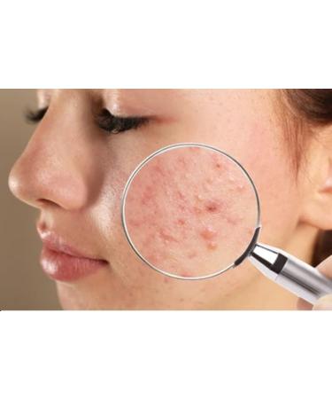 Avena Sulphur Soap & Avena Sulphur Cream Sulfur Ointment Skin Care For Acne Sulphur Ointment Sulfur Soap Large 200g Bar - Buy Online on GoSupps.com