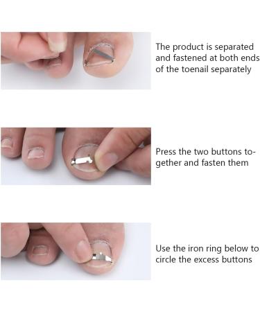 2-Piece Set Stainless Steel Ingrown Toenail Corrector Ingrown Toenail Correction Buckle Paronychia Correction Tool Repairing Nails That Grow Inward to Improve Their Shape and Reduce Pain - Buy Online on GoSupps.com