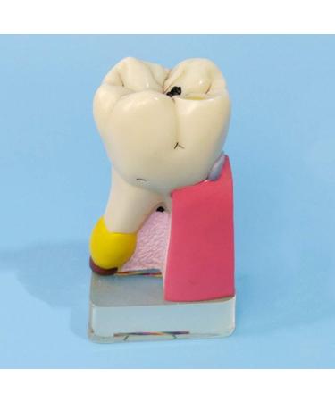 Dytah Dental Implant Model - Tooth Pathology & Crown Bridge Demonstration | Parodontal Sortal Teeth & Gums Educative Model for Dental Care - Buy Online on GoSupps.com
