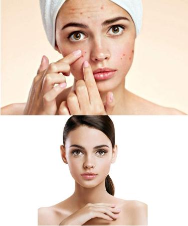 Sebionex Trio Anti-Imperfection Corrective Face Cream 40ML | Shop Internationally for Flawless Skin - Buy Online on GoSupps.com