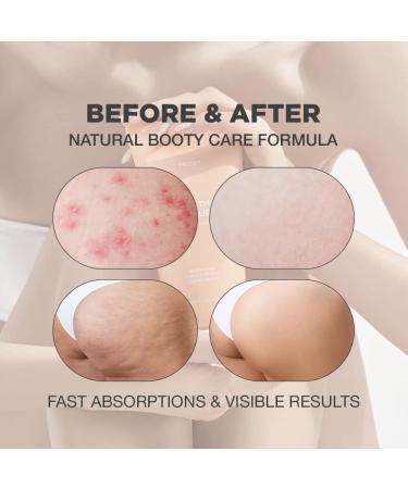 Butt Scrub Wash for Acne, Cellulite, & Ingrown Hair | Exfoliating Body Scrub with Rosemary Extract & Centella Asiatica - Buy Online on GoSupps.com