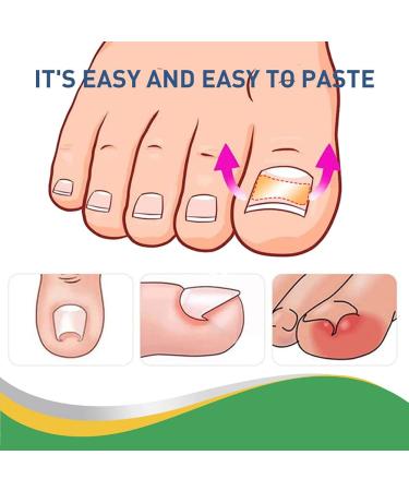 200pcs Ingrown Toenail Corrector Strips - Fitmedify Nail Patches for Toe Nails Fungus - Relief for Ingrown Toenails - Buy Online on GoSupps.com