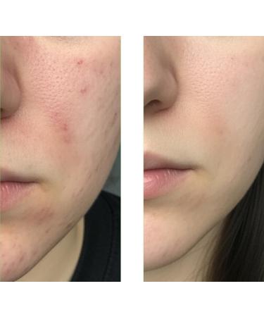  Australian Bodycare Anti-blemish facial cleanser with salicylic acid for pimples blackheads whiteheads oily skin impurities and clogged pores deep cleansing gel with salicylic acid 100 ml - Buy Online on GoSupps.com