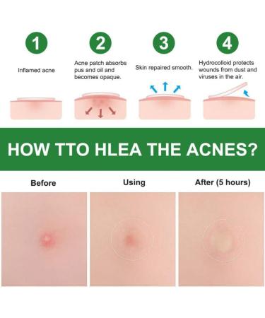 Acne Healing Patch Acne Absorbing Cover Invisible Skin Acne Treatment Stickers for Facial 24Patches acne treatment - Buy Online on GoSupps.com