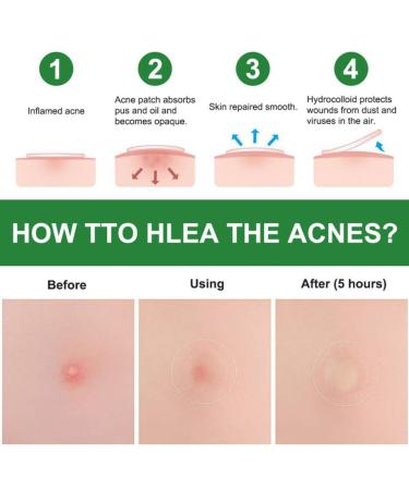 Acne Healing Patches - Invisible Skin Treatment Stickers | 24 Pack for Fast Acne Relief - Buy Online on GoSupps.com