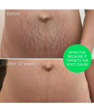 MULTI-AWARD-WINNING Stretch Marks Removal for Men & Women Peptide and Vitamins Stretch Mark & Scar Cream for Reduction in Stretch Marks Improves Elasticity and Firmness Perfect Pregnancy Gift STRETCH MARKS REMOVAL CREAM - Buy Online on GoSupps.com