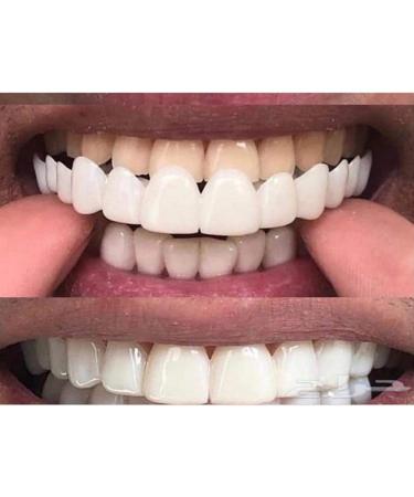 Dental Panel for Perfect Smile | Upper & Lower Tooth Solutions | Comfortable Fit Flexible Braces - Buy Online on GoSupps.com