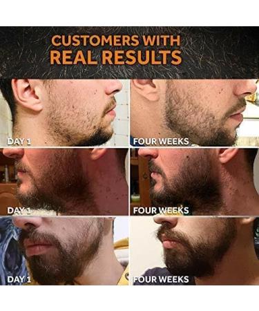 Beayosses Beard Growth Kit Beard Kit Derma roller with Beard Growth Serum Oil (1oz) Stimulate Beard and Hair Growth - Gifts for Men Dad Him Boyfriend Husband Brother - Buy Online on GoSupps.com