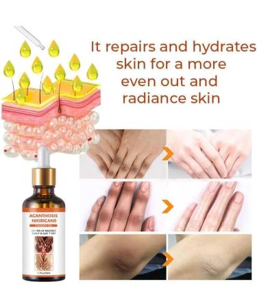 Acanthosis Nigricans Huile de th rapie pour corriger les taches sombres traitement de l'acanthose nigricans limine les taches sombres pour claircir le corps et la peau noire (1 pi ce) 1 pi ce. - Buy Online on GoSupps.com