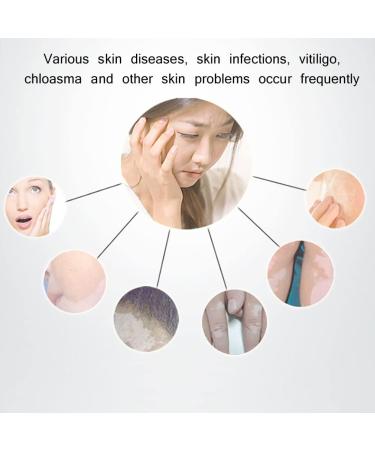 KTROK Woods Lamp Skin Analyzer Black Light Detector with Light Blocking Hood Facial Care Skin for Analyzing Skin Vitiligo Detect Dog Cat Ringworm Detect Moldy Detect - Buy Online on GoSupps.com