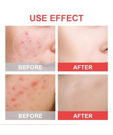 Pimple patch pimple patches hydrocolloid pimples pores cleaning strips for covering pimples and blemishes for face and skin (a) - Buy Online on GoSupps.com