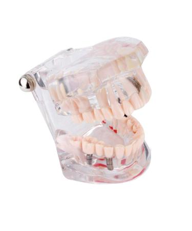 Cocoarm Removable Tooth Model - Dental Care Demo Tool for Teaching Study & Implant Education - Buy Online on GoSupps.com