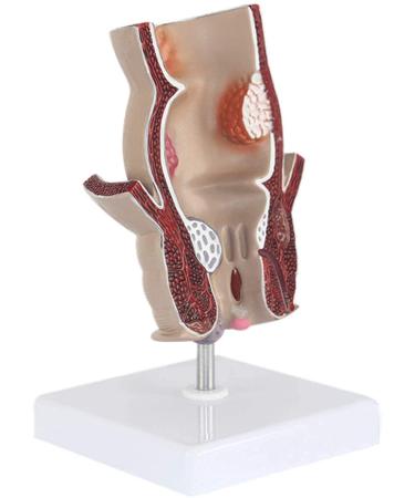 Rectal Pathology Model hemorrhoid Model proctology retal Disease Demonstration 5X Anal Anal and Anal Canal Model Anal and anorect Rectal 11 * 11 * 18.5cm