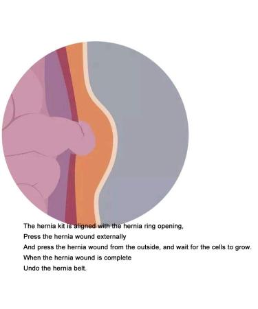 Ultimate Belly Support & Hernia Relief | Unisex Fits Up to 42" Waist | Built-in Hernia Bag for Recovery - Buy Online on GoSupps.com