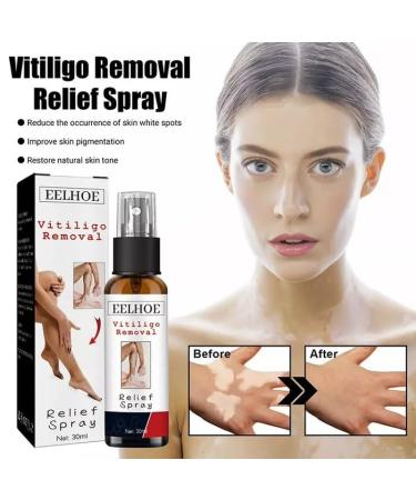NONROT Vitiligo Skin Repair Spray - Reduces White Spots - 4 Count (Pack of 4) - Buy Online on GoSupps.com