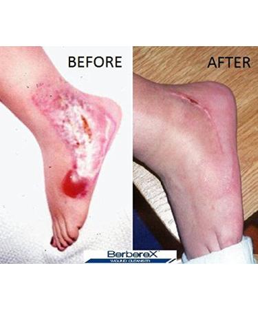 BerbereX Antimicrobial Wound Cleanser 4oz - First Aid Antiseptic Spray for Cuts, Scrapes, Burns, Wounds & Piercings - Buy Online on GoSupps.com